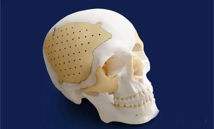  3D-printed PEEK skull implant