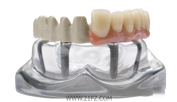 Oral implant restoration